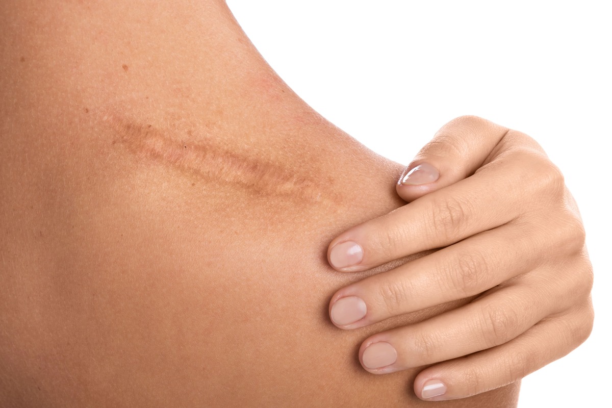 Correção da cicatriz resultante da cesárea isolada ou associada a outros  procedimentos